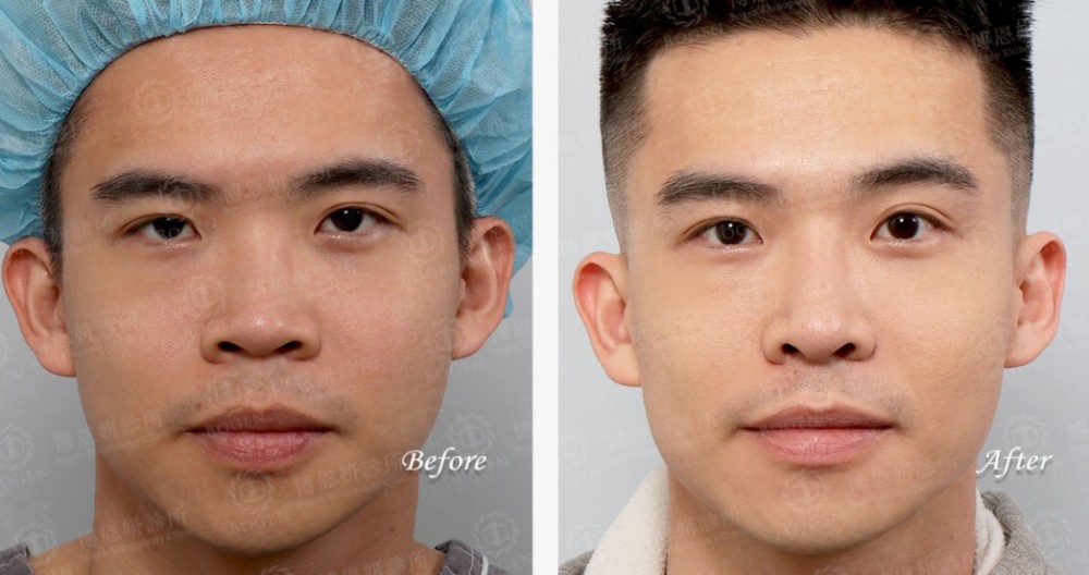 韓式隆鼻,結構式隆鼻,博恩妍